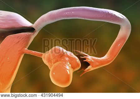 Polycystic Ovary Syndrome, 3d Illustration Showing Enlarged Left Ovary With Cysts