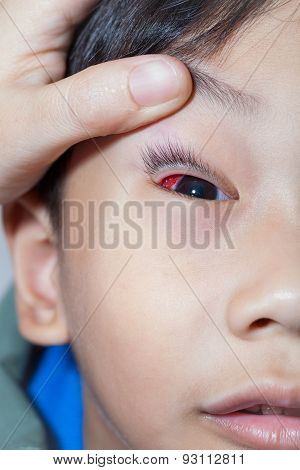Closeup Of Pinkeye (conjunctivitis) Infection On A Boy, Doctor Check Up Eye Patient