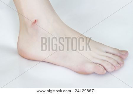 Female Leg On White Background, Cut After Shaving Legs