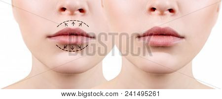 Beautiful Lips Of Young Woman. Before And After Lips Filler Injections. Fillers Concept.