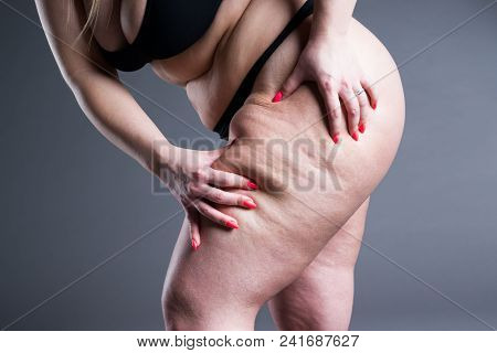 Overweight Woman With Fat Thighs, Obesity Female Legs On Gray Background