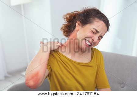 Spreading Rash. Young Lady In Pain Looking Awfully Sick Suffering From A Spreading Skin Rash Affecti
