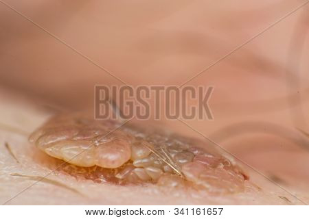 Macro Photo Of A Skin Wart, Papilloma Virus Infection