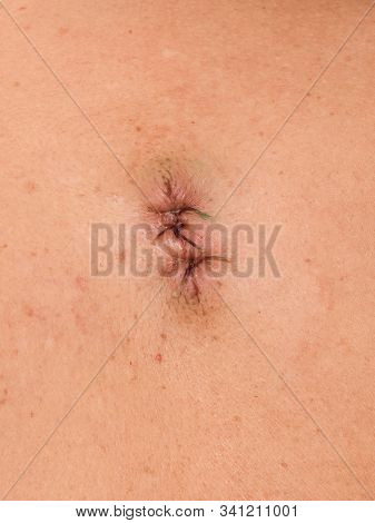 Seam On The Body After Surgeryand, Muscle Injury