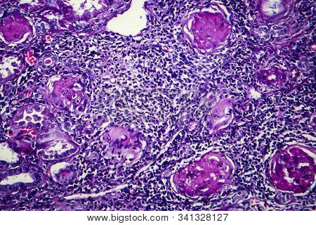 Chronic Nephritis, Light Micrograph, Photo Under Microscope
