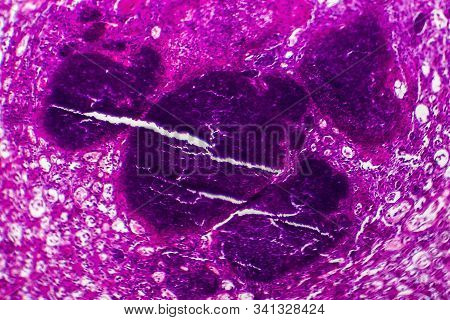Histopathology Of Acute Nephritis, Light Micrograph, Photo Under Microscope