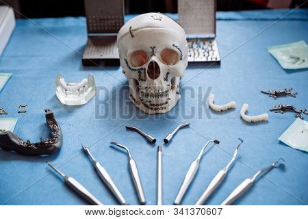 The Model Of The Skull For Maxillofacial Surgery And Dentistry Lies On A Table With Plates Screwed I