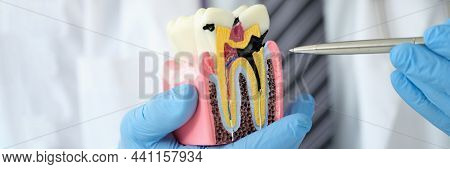 Doctor Dentist Showing Pen On Carious Cavity On Artificial Plastic Model Of Tooth Closeup. Medical D