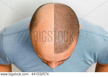 The Head Of A Balding Man Before And After Hair Transplant Surgery. A Man Losing His Hair Has Become