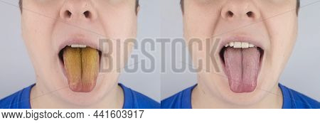 Before And After. Man Has A Yellow Tongue. Painful Yellow Coating On Mucous Membrane Of The Tongue.