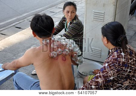 Cupping therapy in Saigon, Vietnam