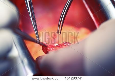 Operating hands of doctors during the cardiac surgery.