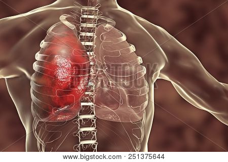 Pneumonia Medical Concept, 3d Illustration Showing Lobar Pneumonia Of The Right Lung