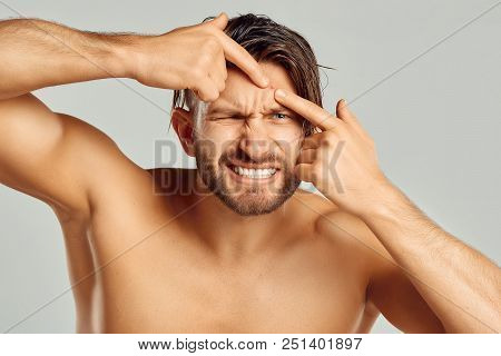 Acne Spot Pimple Spot Skincare Beauty Care Male Pressing On Skin Problem Face.young Man Squeezing He