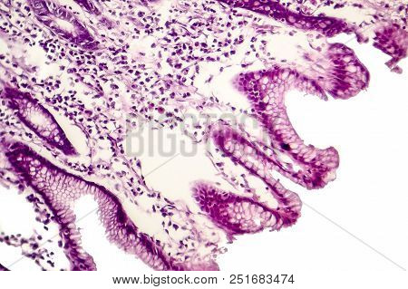 Intestinal Metaplasia Of Stomach, Light Micrograph, Photo Under Microscope