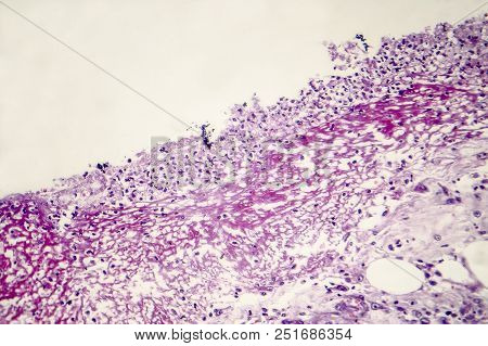 Bacterial Dysentery, Light Micrograph, Photo Under Microscope Showing Accumulation Of Inflammatory C