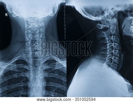 X-ray Picture Of The Cervical Spine Of A Man In Two Projections In Full View And Profile