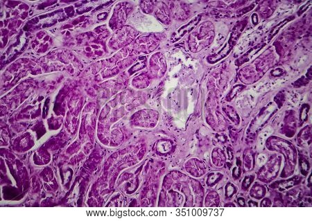 Diffuse Proliferative Glomerulonephritis, Dpgn, Light Micrograph, Photo Under Microscope