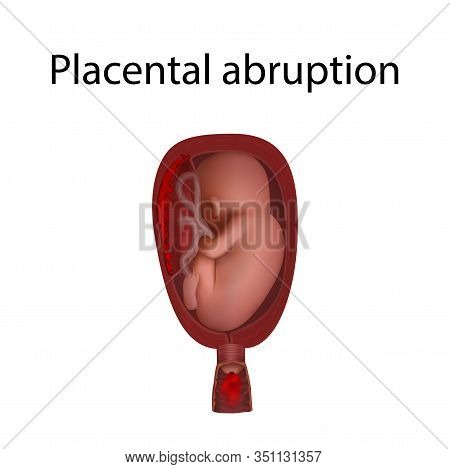Placental Abruption. Fetus In Uterus, Womb, Placenta, Umbilical Cord. Hi-risk Pregnancy Complication