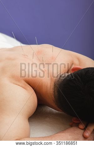 Man With Acupuncture Needles In His Back Is Receiving Treatment In A Traditional Chinese Medicine Cl