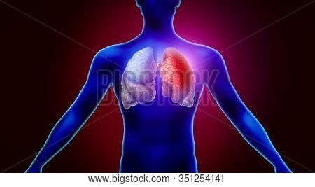 Human Lung Infection And Respiratory Inflammation Disease As Influenza Flu Outbreak Or Pneumonia And