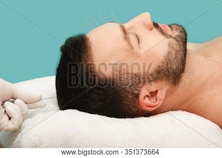 Acupuncturist Inserting Acupuncture Needles Into Patients Skin Head. Close-up Acupuncture Needles In