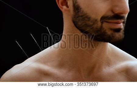 Close-up Portrait Of A Male Patient With Acupuncture Needles In His Shoulder On A Black Background. 