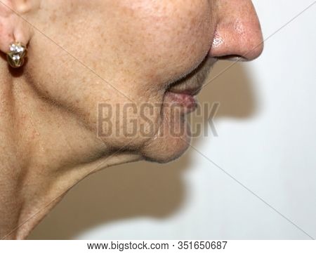 Nasolabial Wrinkles. Wrinkles On The Skin Of The Face Of The Neck. Flabby Cheeks And Neck