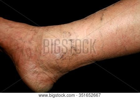Leg. Varicose Veins. Phlebeurysm. Thrombophlebitis. Leg In Veins.