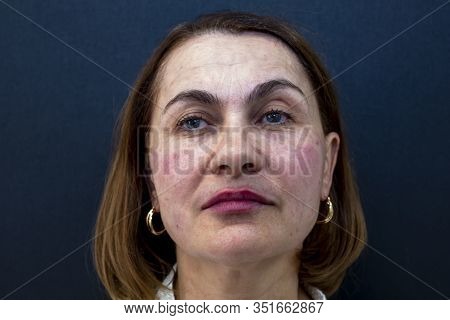 An Elderly Woman Immediately After Injections Of Botulinum Toxin, Closeup. Skin Care Concept. Aethet