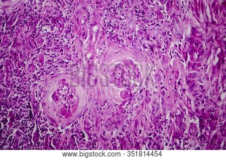 Chronic Glomerulonephritis, Light Micrograph, Photo Under Microscope