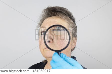 Rosacea On The Skin Of An Old Woman. Close-up Of A Capillary Network. Redness On The Skin. Problems
