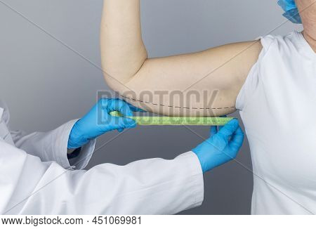 Brachioplasty. Plastic Arms, Dangling Skin At The Elbow. An Older Woman Shows The Surgeon Problem Ar