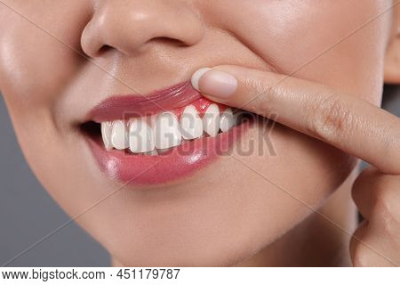 Young Woman Showing Inflamed Gums On Grey Background, Closeup