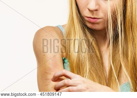 Itchy Skin, Dermatitis, Food Allergies. Woman Having Itching, Scratching Her Arm With Allergy Rash.
