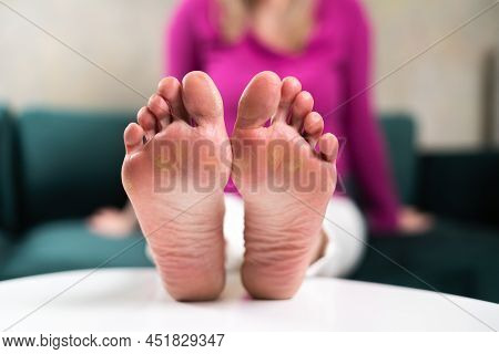 Close Up Of Woman Legs With Callus On It. Feet With Corn Caused Of Heels. Need Of Pedicure