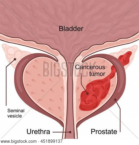 Medical Diagram Of 3 Stage Of Prostate Cancer.