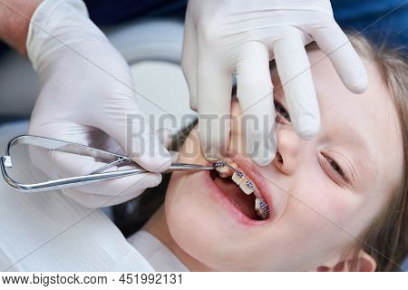 Braces for child teeth correction. Installation and maintenace