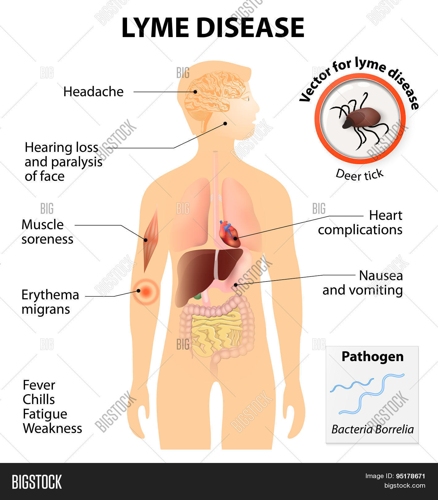 Lyme Disease Lyme Vector & Photo (Free Trial) Bigstock
