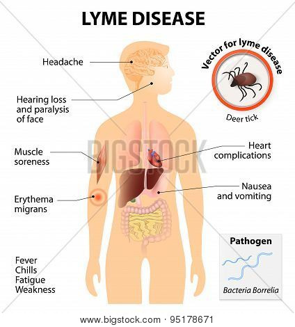 Lyme Disease Or Lyme Borreliosis