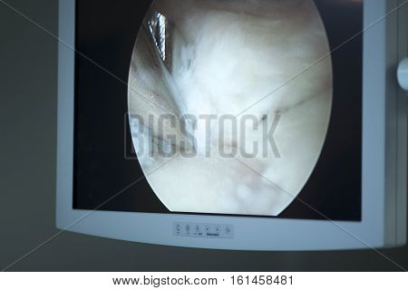 Arthroscopy Surgery Screen