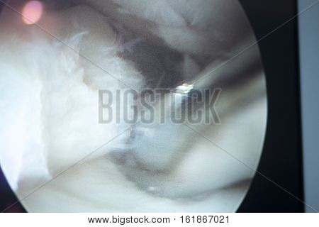 Arthroscopy Surgery Screen