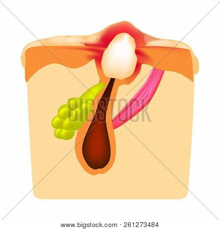 Inflammatory Comedones. Acne. The Structure Of The Skin. Infographics. Vector Illustration On Isolat