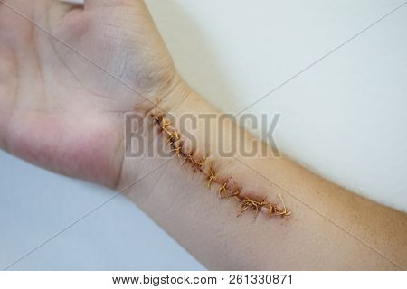 Humand Hand Hurt With A Big Scar With A Lot Of Stitches. Horizontal Shot