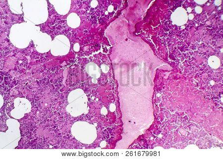 Lobar Pneumonia, Hemorrhagic Edema Period, Light Micrograph, Photo Under Microscope