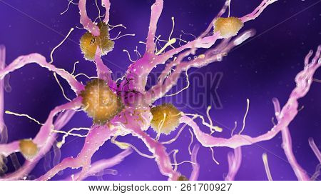 3d rendered medically accurate illustration of amyloid plaques on a alzheimer nerve cell