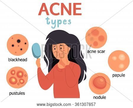 Acne Infographic. Unhappy Girl Struggling With Acne, Pimples. Skin Face Irritation Problem.