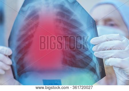 A Doctor Pulmonologist In Medical Uniform Examines An X-ray Of The Patient's Lungs. Pandemic Covid-1