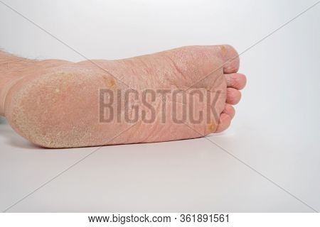 Fungus Of The Foot Of A Person.