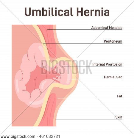 Umbilical Hernia. Part Of The Intestine Bulges Through The Opening